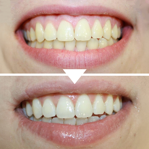 blanqueamiento dental