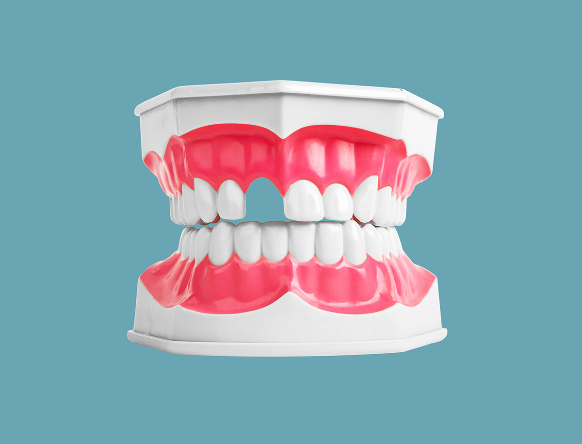¿Te faltan dientes? Descubre el edentulismo