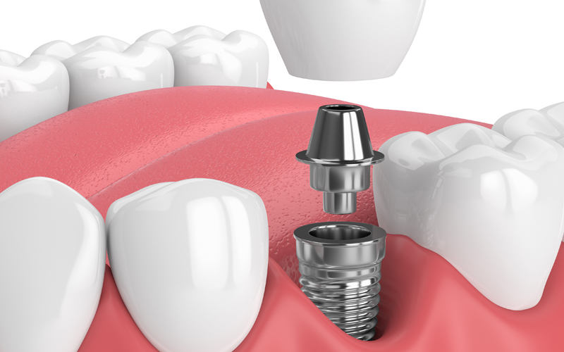 Implantes dentales unitarios