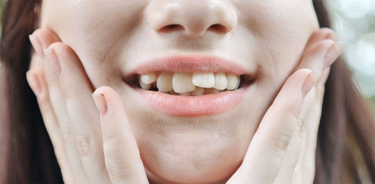 Tengo los Dientes Apiñados, ¿Cómo puedo solucionarlo?
