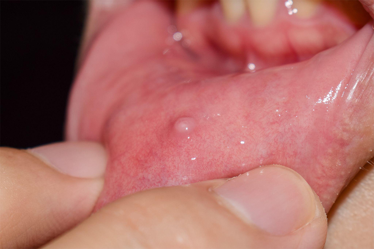 ¿Bulto en el labio? Todo sobre el Mucocele: Causas y Tratamiento en Alicante – Guía Completa 2026