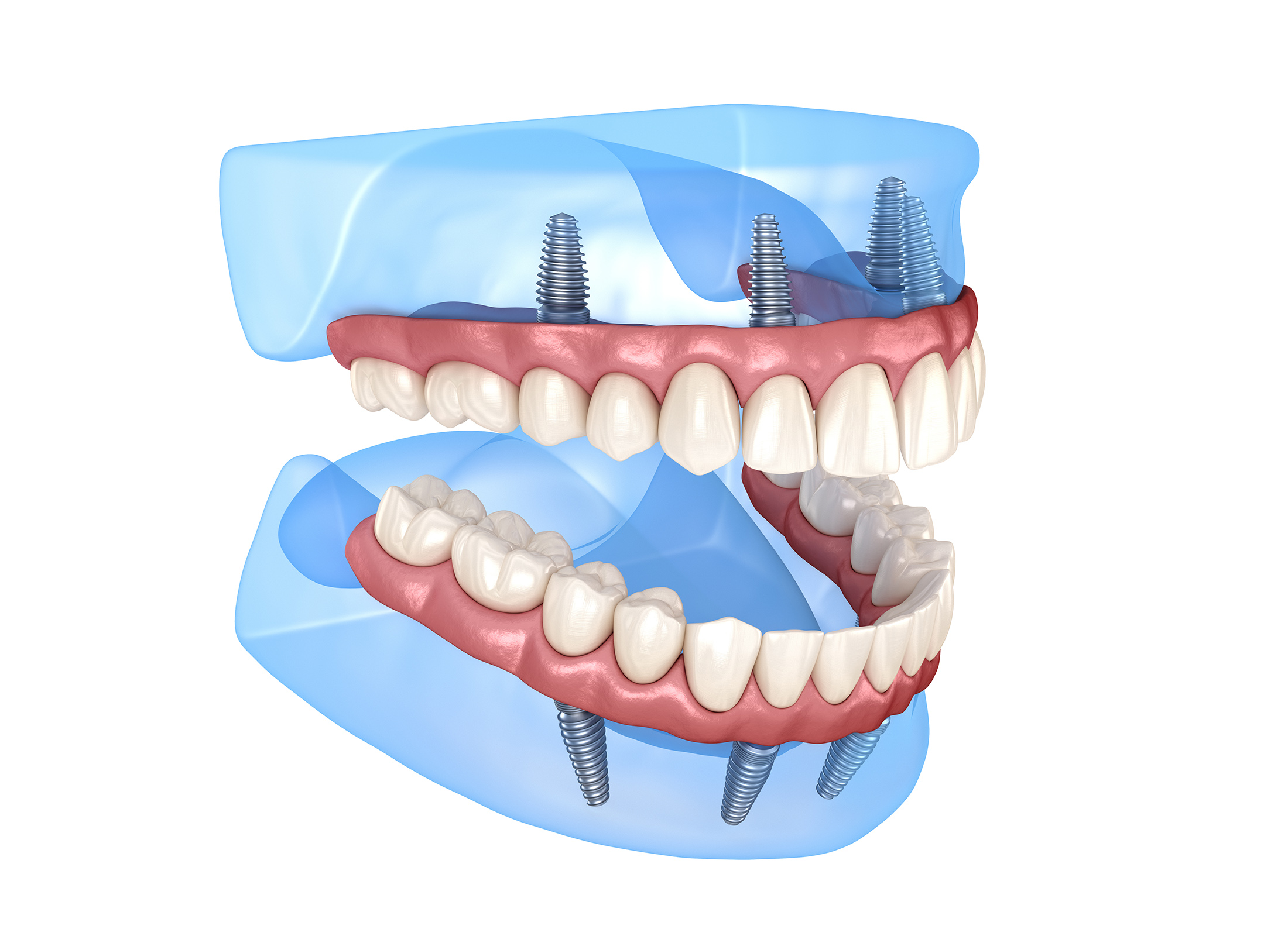 ¿CUÁNTO CUESTA PONERSE IMPLANTES EN TODA LA BOCA?